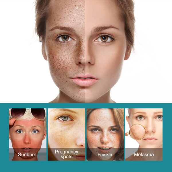 Whitening Spot Cream Hydrates And Moisturizes Skin To Lighten Spots, Acne Whitening, Brightening And Rejuvenating Skin Beauty Cream